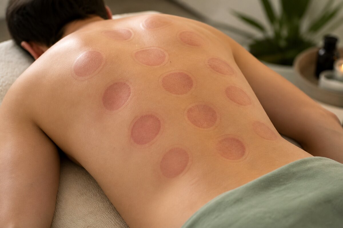 Dry cupping — circular cupping marks across the back after a session